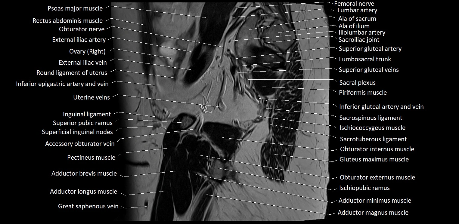 Sagittal cross sectional anatomy of female pelvis (MRI 3T) image 8.webp